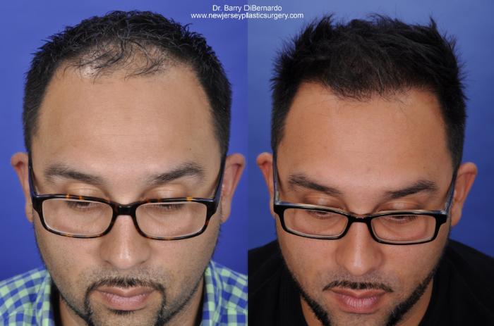 SmartGraft Hair Transplant Case 40 Before & After Front | Houston, TX | DermSurgery Associates