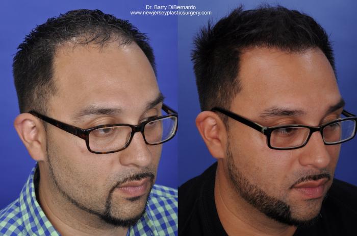 SmartGraft Hair Transplant Case 40 Before & After Right Oblique | Houston, TX | DermSurgery Associates