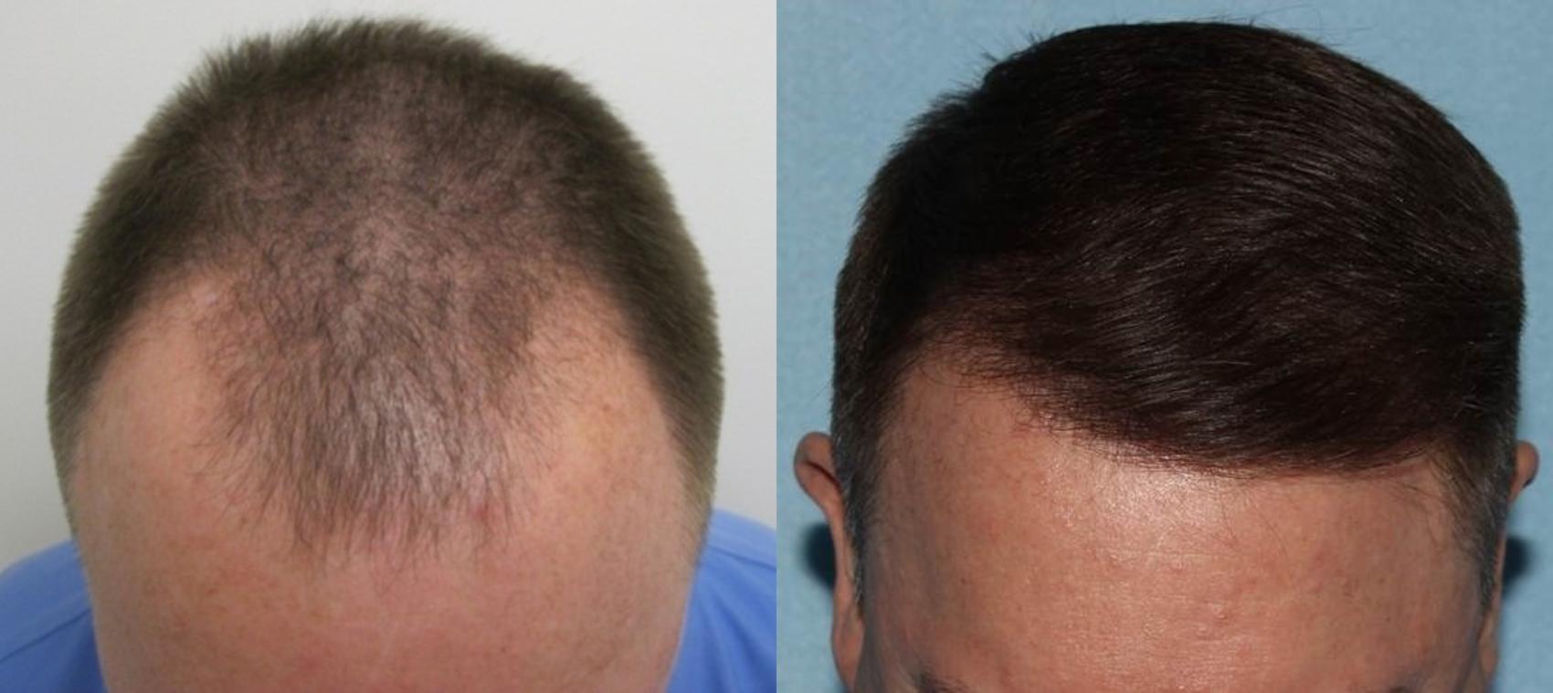 SmartGraft Hair Transplant Case 41 Before & After Top of Head Front | Houston, TX | DermSurgery Associates