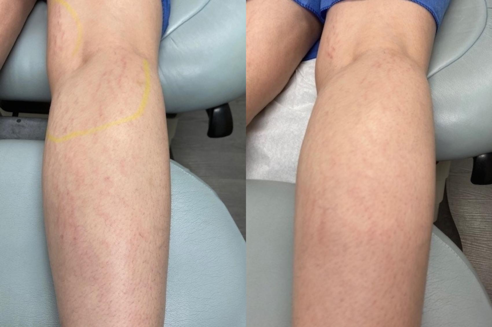 Stretch Mark Treatment Case 52 Before & After Front | Houston, TX | DermSurgery Associates