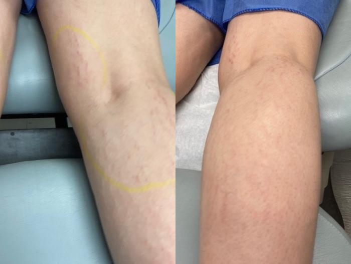 Stretch Mark Treatment Case 52 Before & After Right Oblique | Houston, TX | DermSurgery Associates