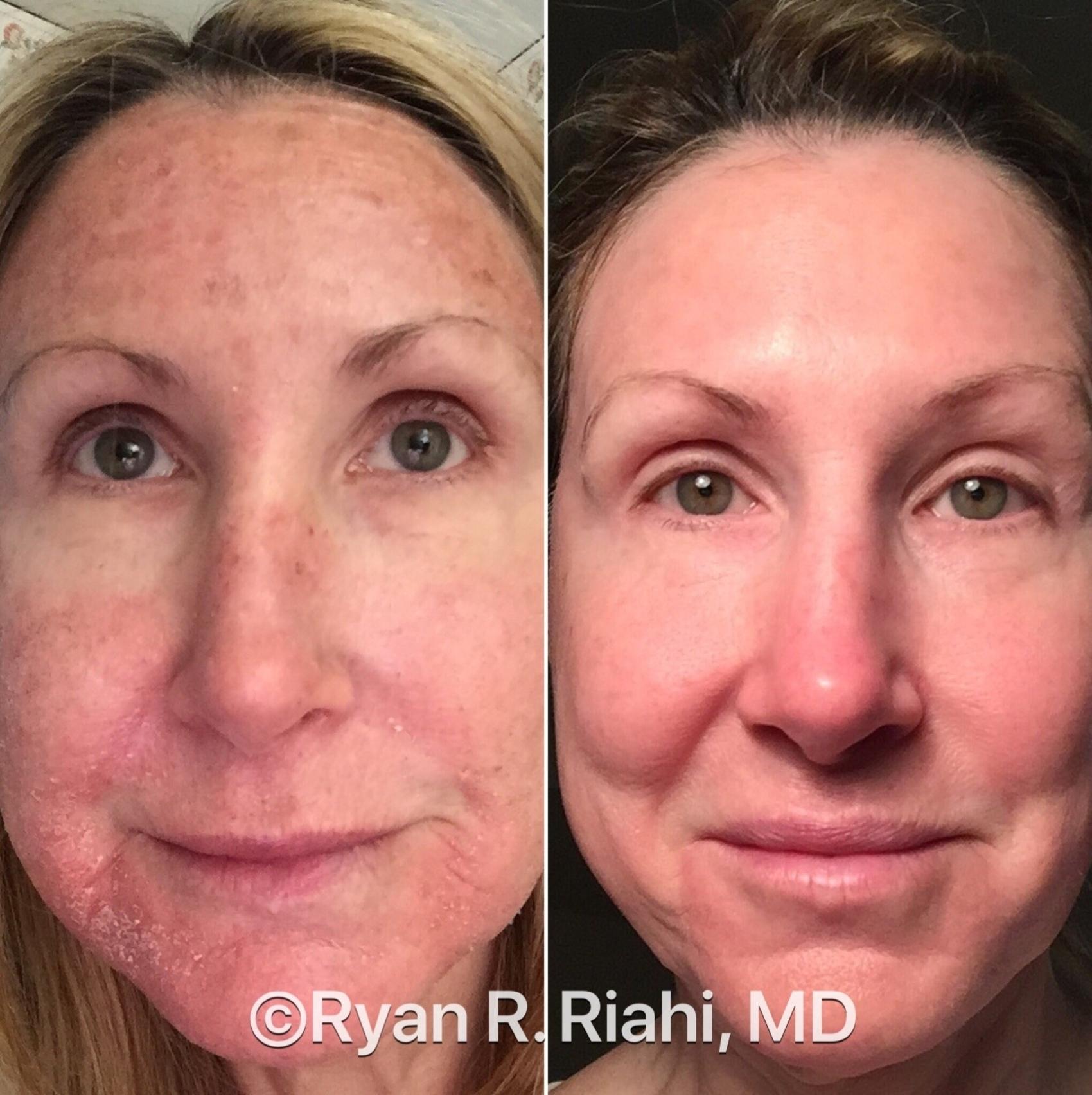 sun-damage-treatment-before-after-photos-patient-46-houston-tx