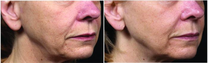 Thermage Case 25 Before & After Right Oblique | Houston, TX | DermSurgery Associates