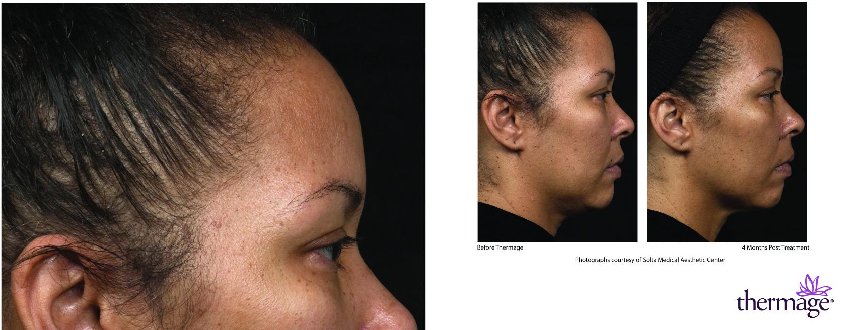 Thermage Case 26 Before & After Right Side | Houston, TX | DermSurgery Associates