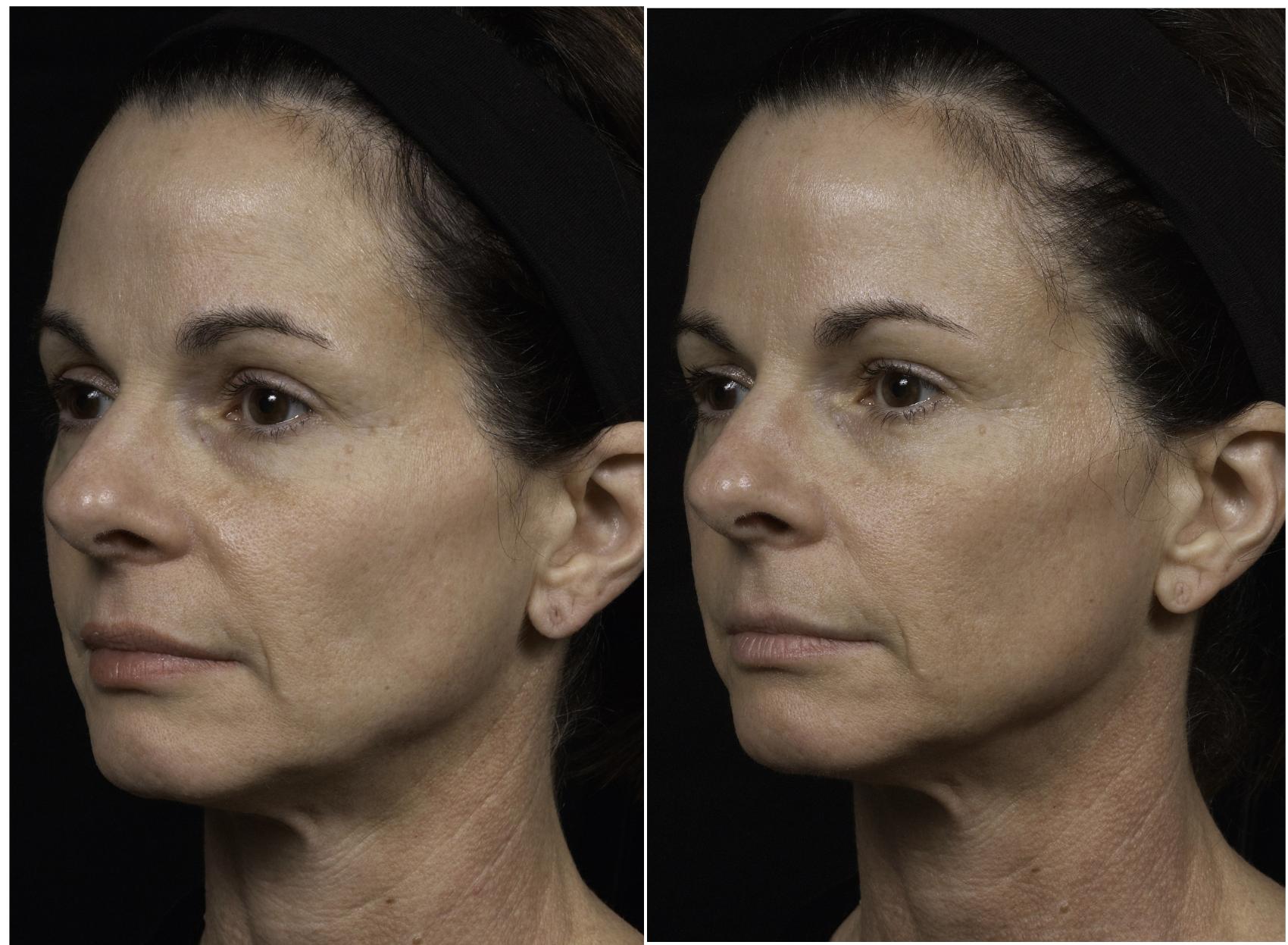 Thermage Case 29 Before & After Left Oblique | Houston, TX | DermSurgery Associates