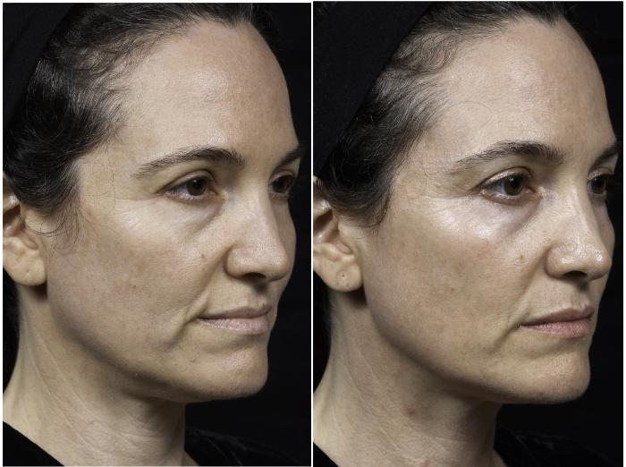 Thermage Case 30 Before & After Left Oblique | Houston, TX | DermSurgery Associates