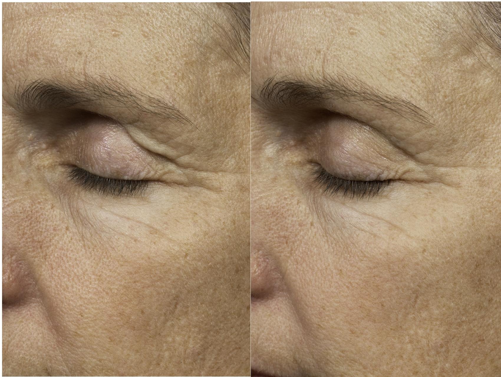 Thermage Case 31 Before & After Front | Houston, TX | DermSurgery Associates