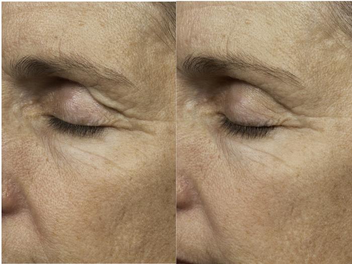 Thermage Before & After Photos Patient 31 | Houston, TX
