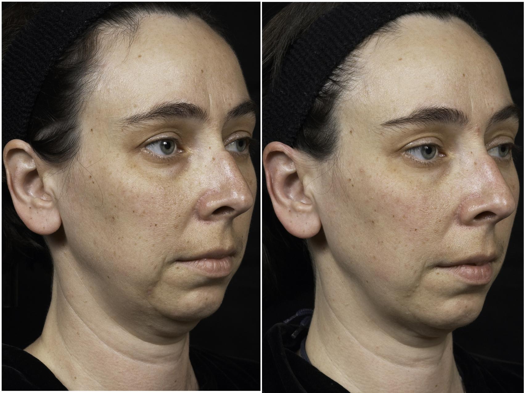 Thermage Before And After Photos Patient 32 Houston Tx Dermsurgery