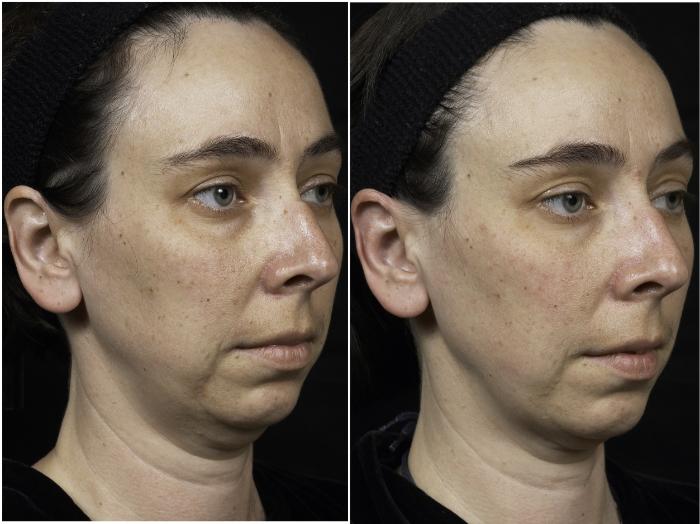 Thermage Case 32 Before & After Right Oblique | Houston, TX | DermSurgery Associates