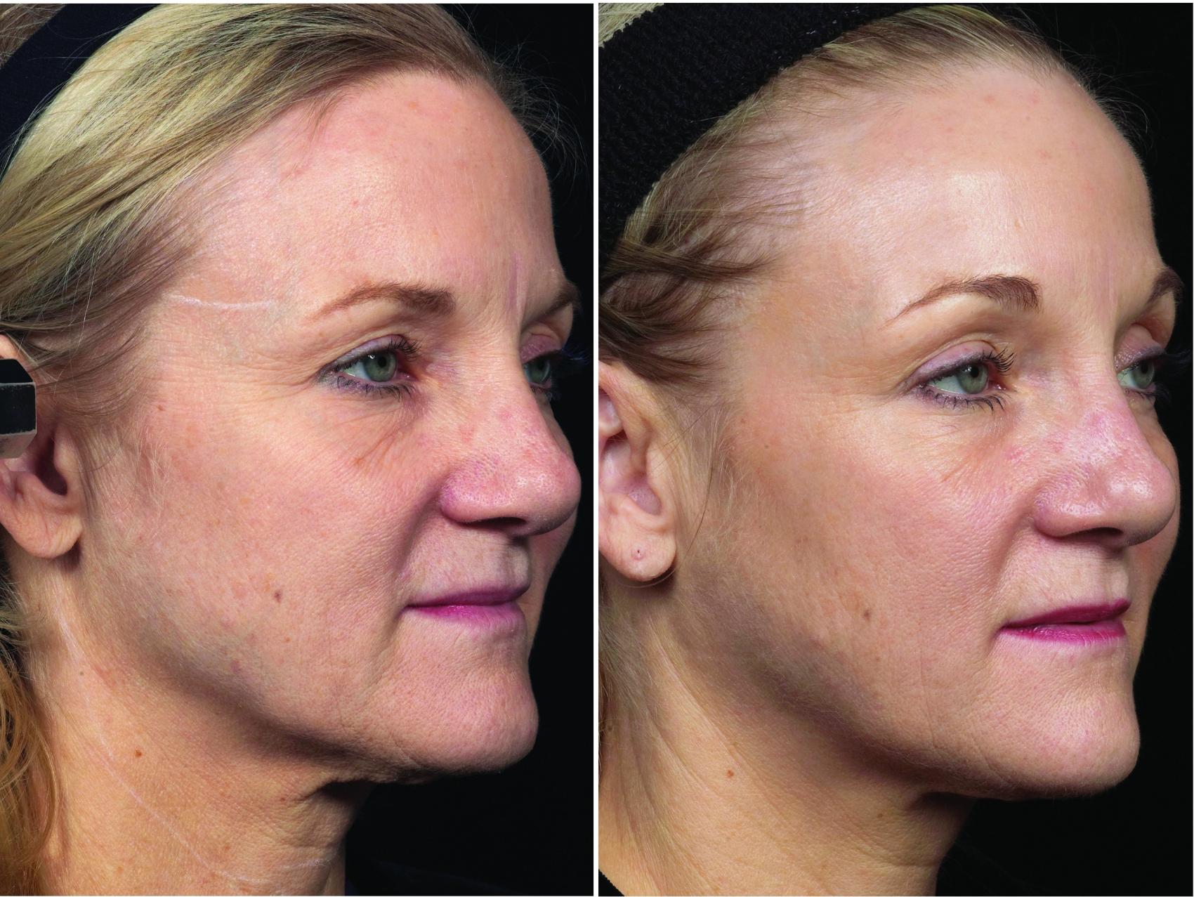 Thermage Case 34 Before & After Right Oblique | Houston, TX | DermSurgery Associates