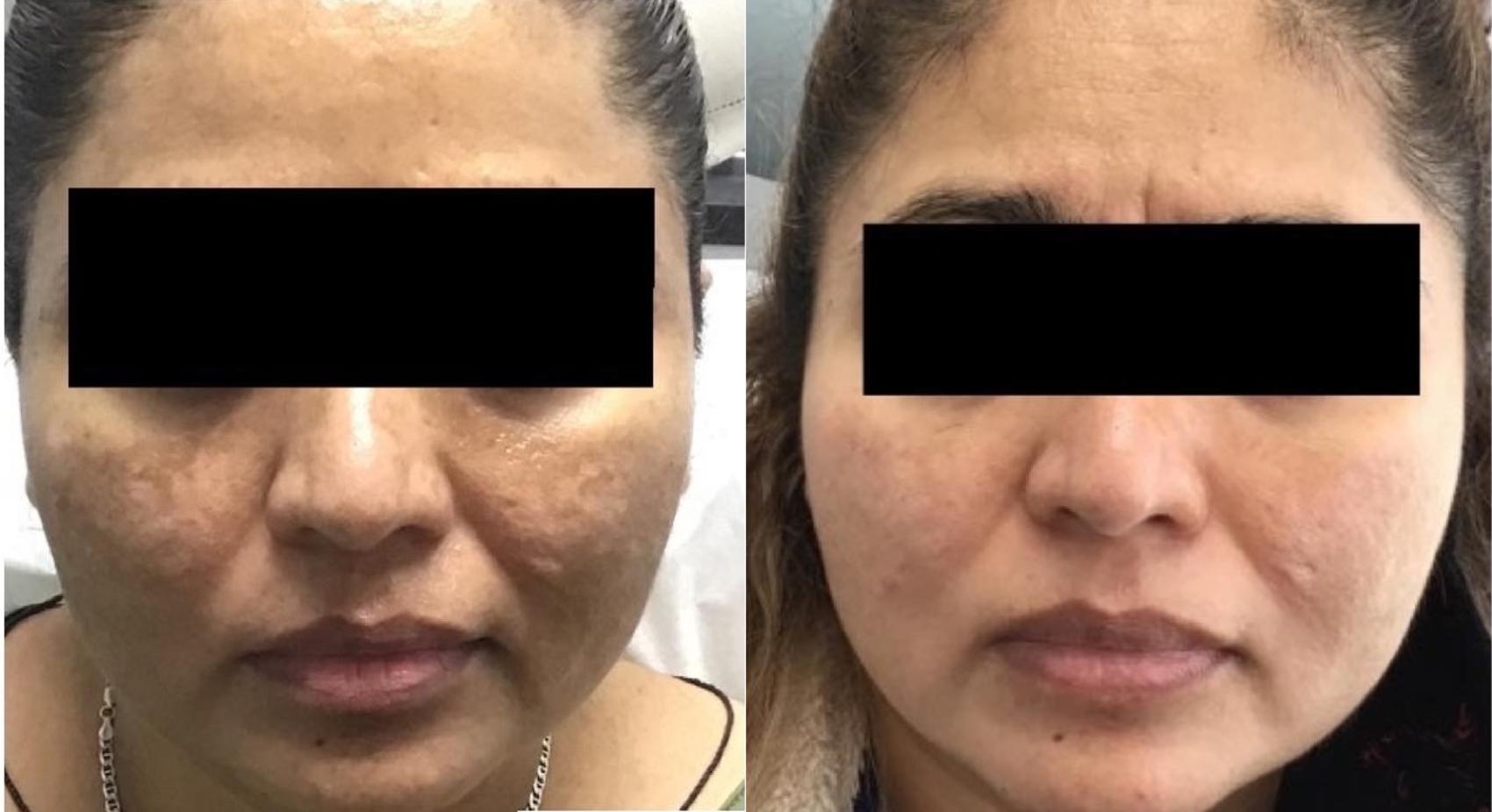 Topical Treatment for Melasma Case 43 Before & After Front | Houston, TX | DermSurgery Associates