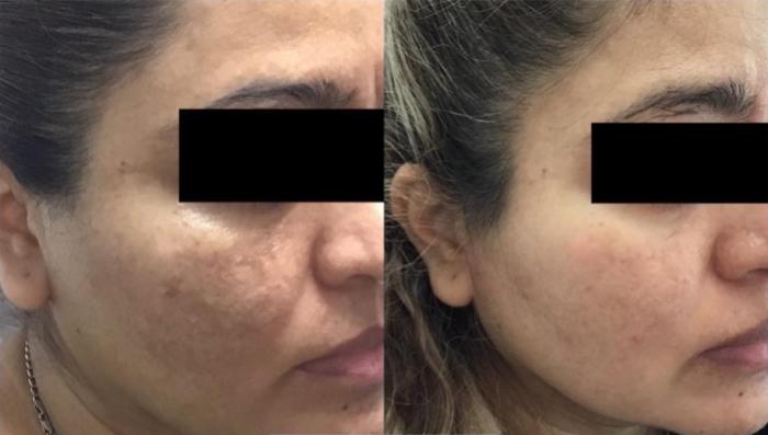 Topical Treatment for Melasma Case 43 Before & After Right Oblique | Houston, TX | DermSurgery Associates
